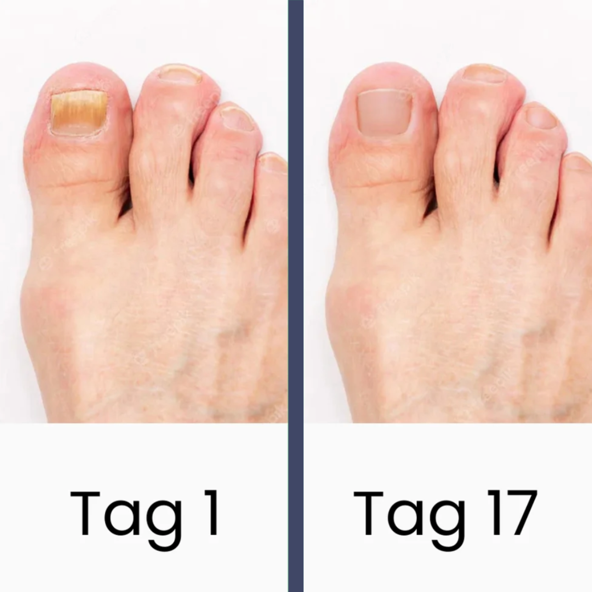 NailCare – Fungal Nail Treatment with UV Light