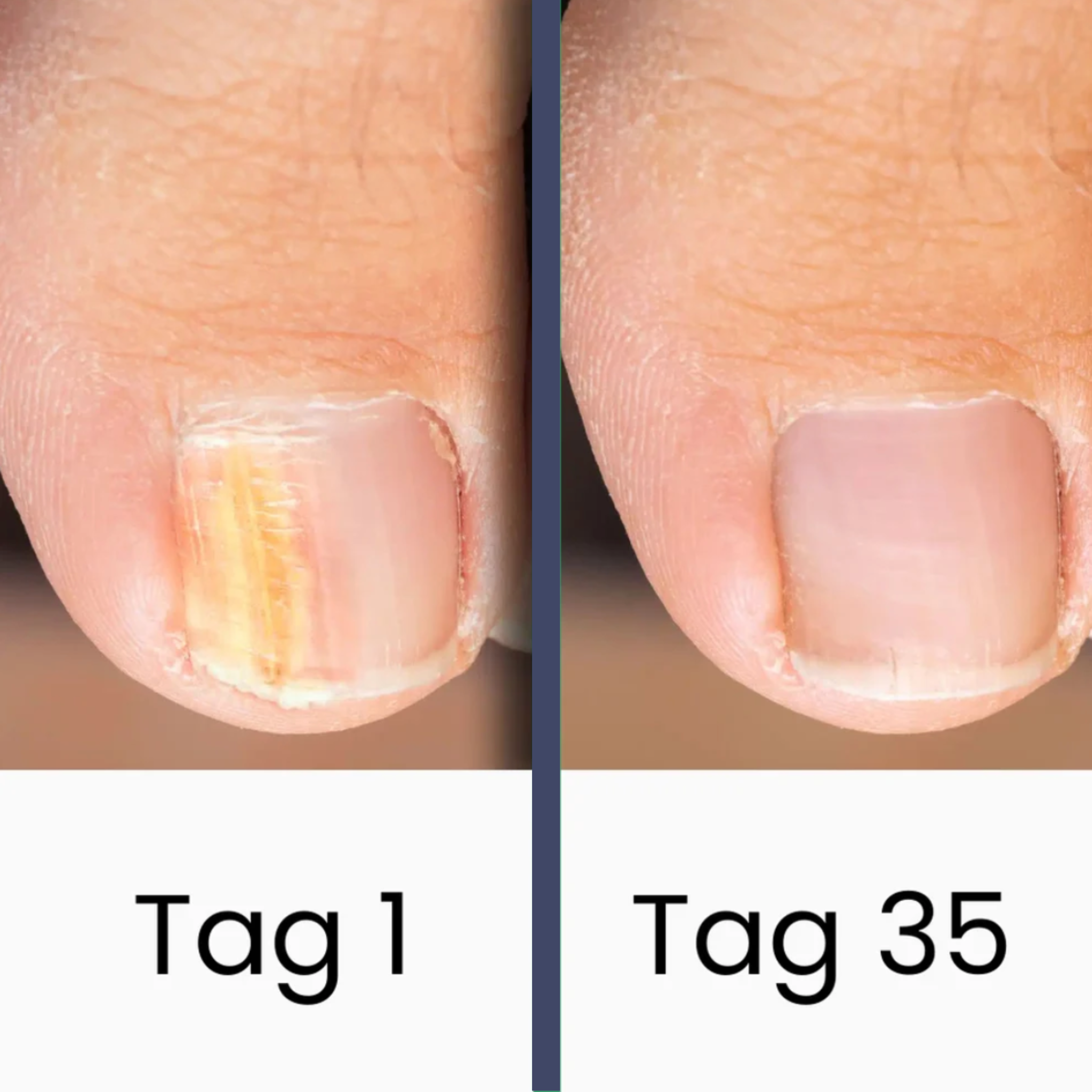NailCare – Fungal Nail Treatment with UV Light
